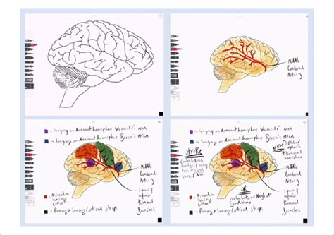 Still Images Taken From The Middle Cerebral Artery Stroke Soton Brain