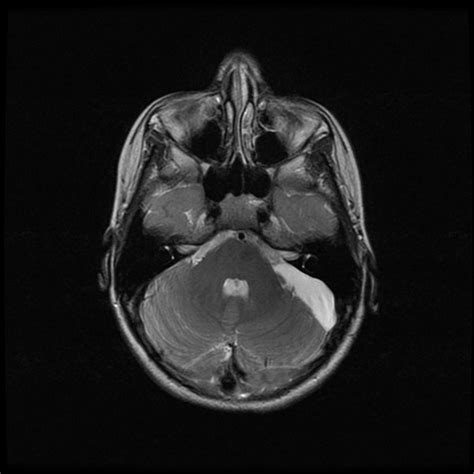 Arachnoid Cyst Left Cerebellopontine Angle Image