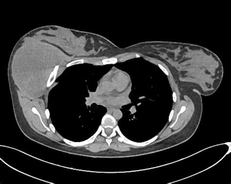 Intercostal Nerve Plexiform Neurofibroma Image Radiopaedia Org