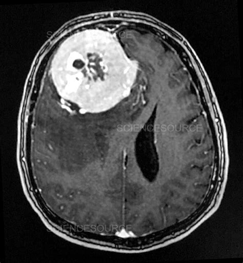 Photograph | Large Frontal Meningioma, MRI | Science Source Images