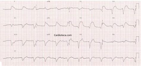 Curso Ecg Infarto Agudo De Miocardio En Paciente Que Tiene Un Marcapasos