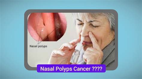 Nasal Polyps Type