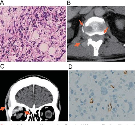 Figure 1 From A Case Of Myeloid Sarcoma With Correlation To JAK2V617F