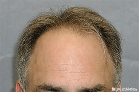 Patient Bsi Bernstein Medical Center For Hair Restoration