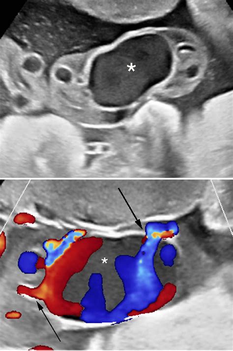 Upper Panel Real Time Sonography Depicting Echogenic Mass Within Download Scientific