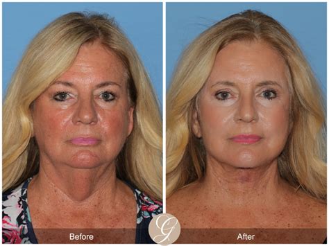 The Difference Between Deep Plane Facelift And Smas Facelift Sadati Md