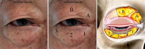 Eyelid Surgery By Prof Dr Cn Chua 蔡鐘能 2015