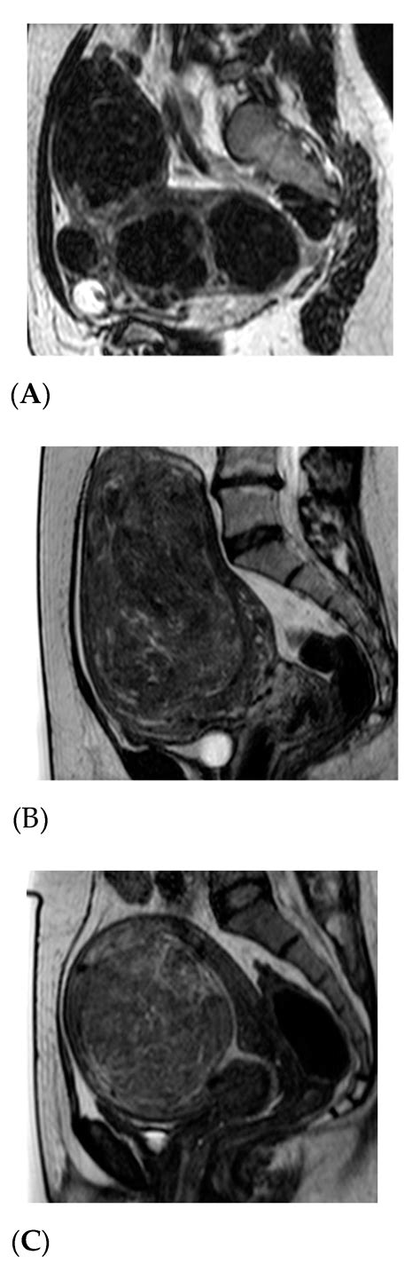 Fibroids Body Mri