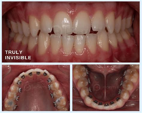 Invisalign Vs Braces Results