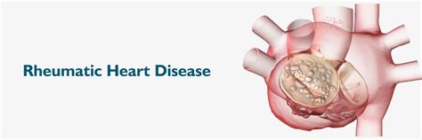 Rheumatic Heart Disease Causes Symptoms And Treatment