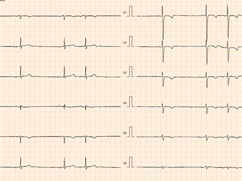 12lead ECG Demonstrated Sinus Bradycardia A Right Axis Deviation A