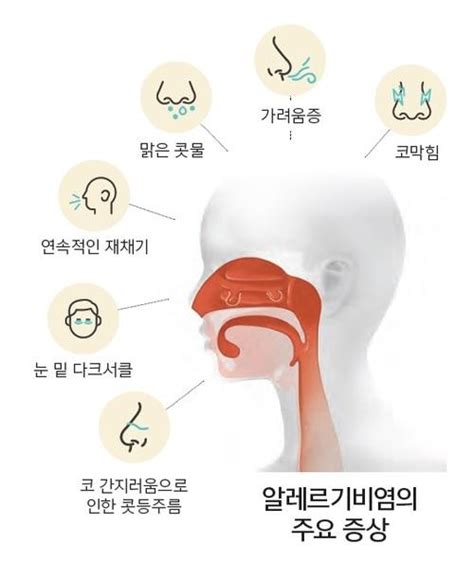 알레르기비염의 원인과 치료방법 냥냥이 블로그