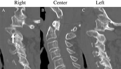 Sagittal Computed Tomography Ct Reconstruction Images Before Surgery