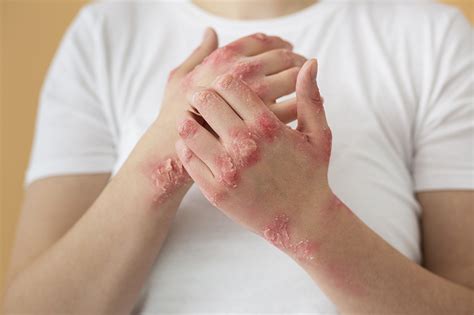 Psoriasis ICD 10 Codes Explained Including Inverse 54 OFF