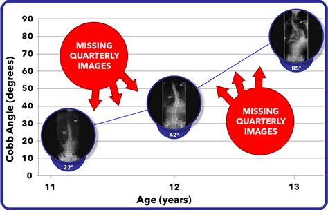 Scoliosis MRI Monitoring - Radiation Free - Scoliosis Care Centers