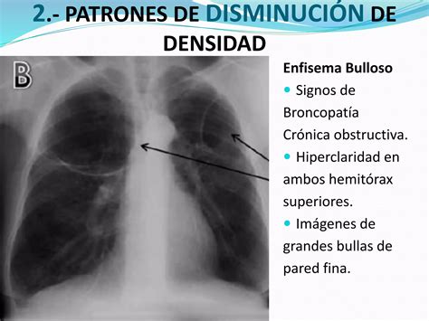 Principales Patrones Radiológicos En La Placa Simple De Tórax Ppt