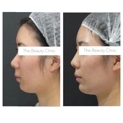 Non Surgical Nose Thread Lift With Aptos Threads The Beauty And