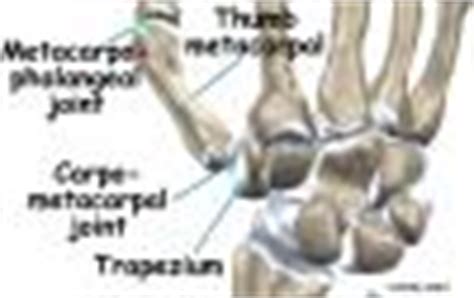 Artificial Joint Replacement of the Thumb | eOrthopod.com