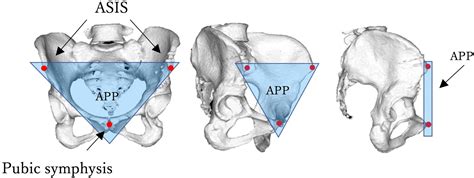 Visualization Of Acetabular Coverage With Radar Chart Before And After