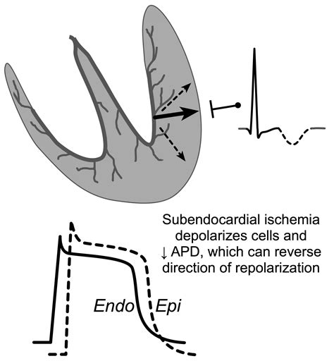 Subendocardial Infarction Ecg