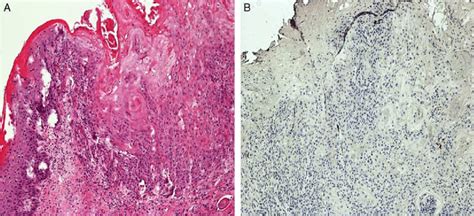 Superficially Invasive Well Differentiated Squamous Cell Carcinoma A