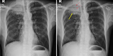 Lung cancer: Adenocarcinoma – Radiology Cases