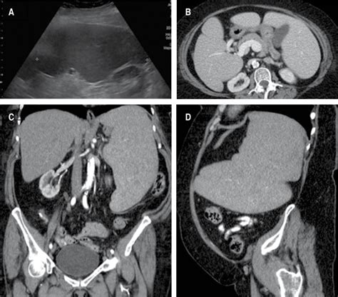 Hand Assisted Laparoscopic Splenectomy For Massive Esplenomegaly