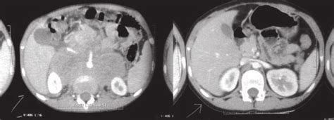 CT abdomen at presentation Fig.-2: CT abdomen after completion... | Download Scientific Diagram