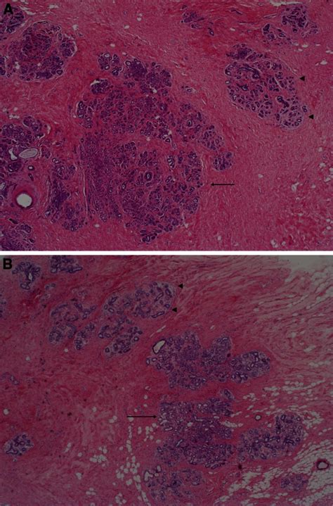 ×20 Photomicrographs Of Sclerosing Adenosis A Large Central Area Of