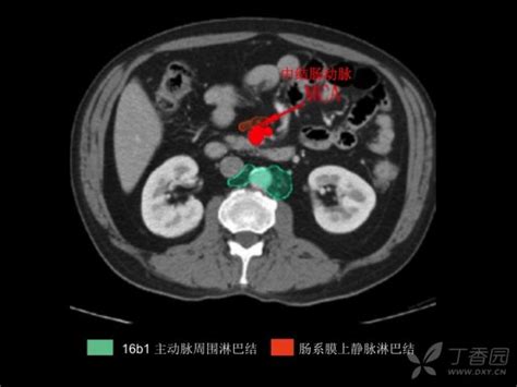 胃癌淋巴引流区分布搞不清看看这个图谱 丁香园