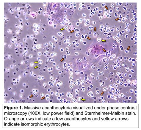 Urine Sediment of the Month: Dysmorphic Red Blood Cells, Blebs ...