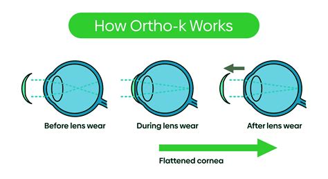 Orthokeratology Lenses A Comprehensive Guide To Overnight Vision