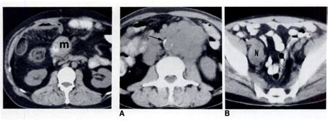 Calcified Mesenteric Mass Soft Tissue 5fig 5 Retroperitoneal Download Scientific Diagram