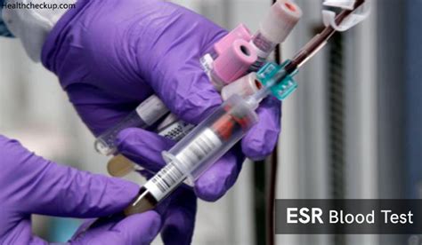 ESR Test Procedure Normal Ranges And Causes Of Low And High ESR