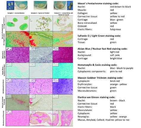 Figure A1 Histological Overview Of Loose Bodies And Synovial Pocket