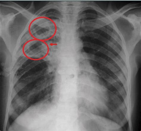 INTERPRETARE RADIOGRAFIE PULMONARA - DRWEATHER BLOG