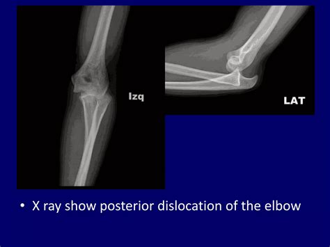 Dislocations of joint. Joint Dislocation | PPT