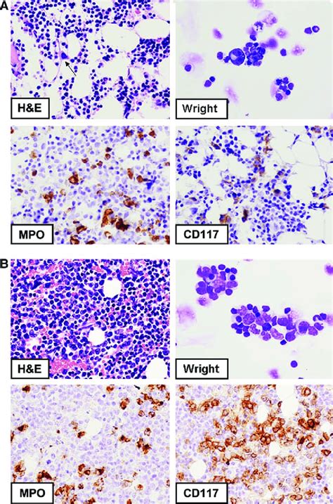 Pathology Of Bone Marrow Biopsies Years After Busulfan