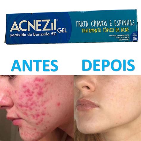 Pomada Creme Acnezil Gel G Tratamento Anti Acne Contra Cravos E