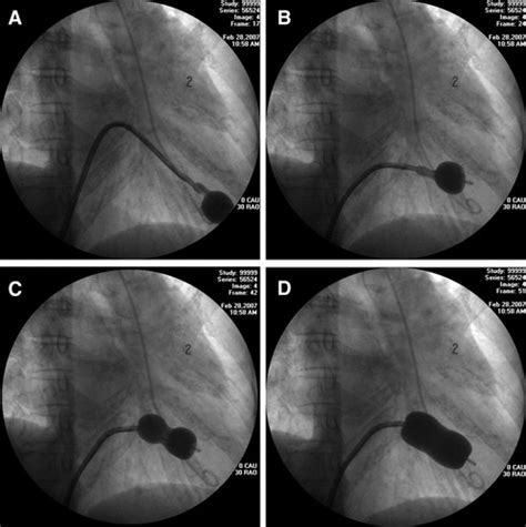 Percutaneous Balloon Mitral Valvuloplasty Circulation