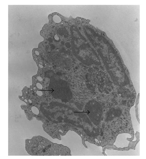 Electron Microscopy Of A Neutrophil Granulocyte Of Our Patient The