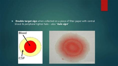 Csf Rhinorrhea Overview