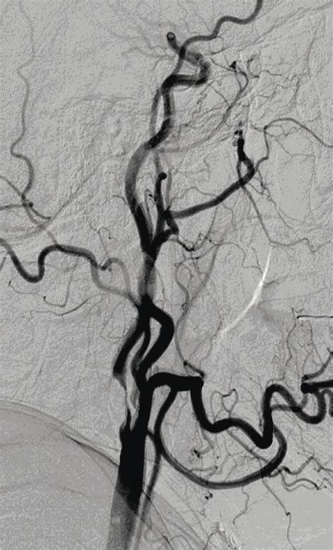 Carotid Artery Stenosis The Operative Review Of Surgery