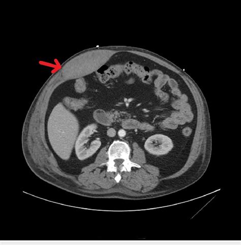 Computerized Tomography Findings Demonstrating A Rectus Sheath Hematoma