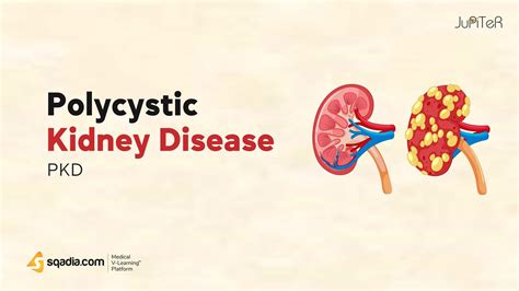 Polycystic Kidney Disease