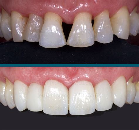 Prótesis dentales puentes y coronas dentales Clínica Orgaz Dental