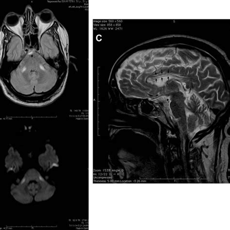 E Aeb Mri Brain Axial Flair Images And Dwi Showing Bilateral Symmetric