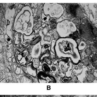 Transmission Electron Microscopy Of Right Ventricular Endomyocardial