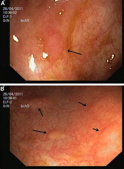 Endoscopic Image Of Colonic Mucosa Notes A Colonic Mucosa Erosion