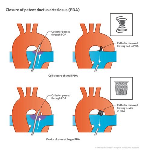 Pda Patent Ductus Arteriosus Closure — Golden Shutter Films